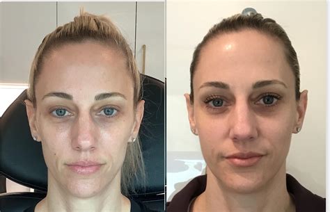 Results last up to <strong>2</strong> years. . 2 vials of sculptra before and after hips